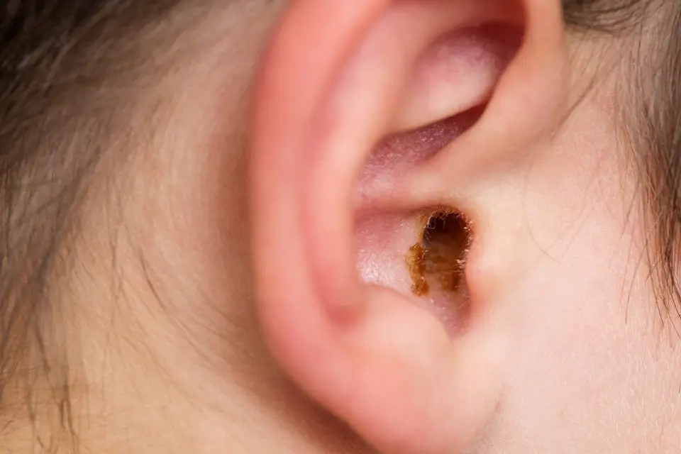 Black ear wax - featured image